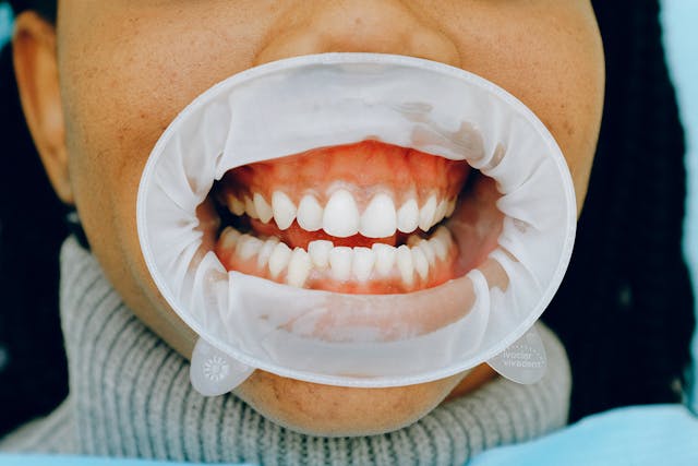 Can You Whiten Teeth If You Have Gum Recession?